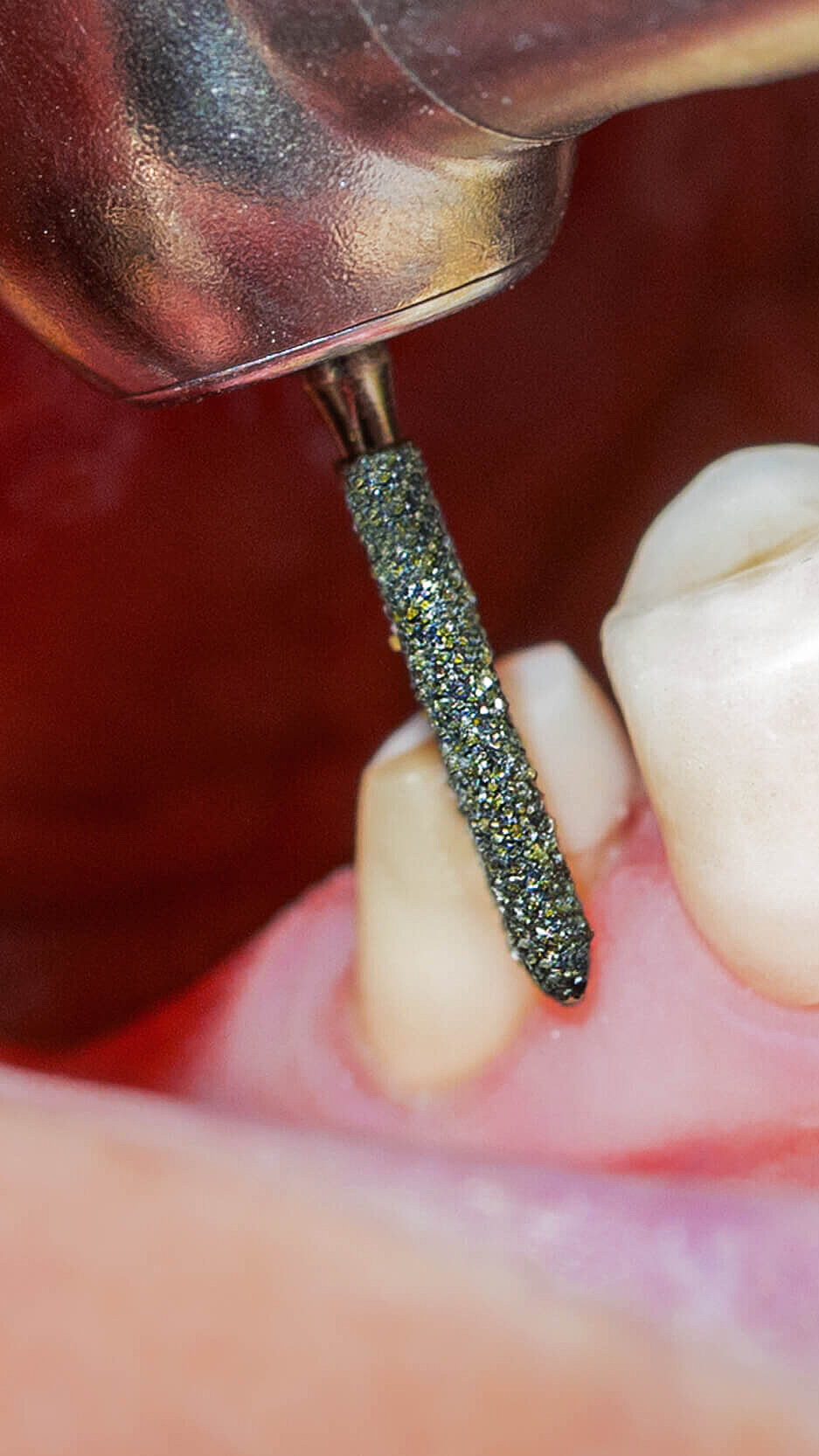 Zahnbehandlung am Patienten mit einem Diamantbohrer von acurata austria.